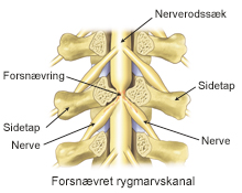 http://www.aleris.dk/Global/da/Specialer/Rygkirurgi/Spinalstenose.jpg
